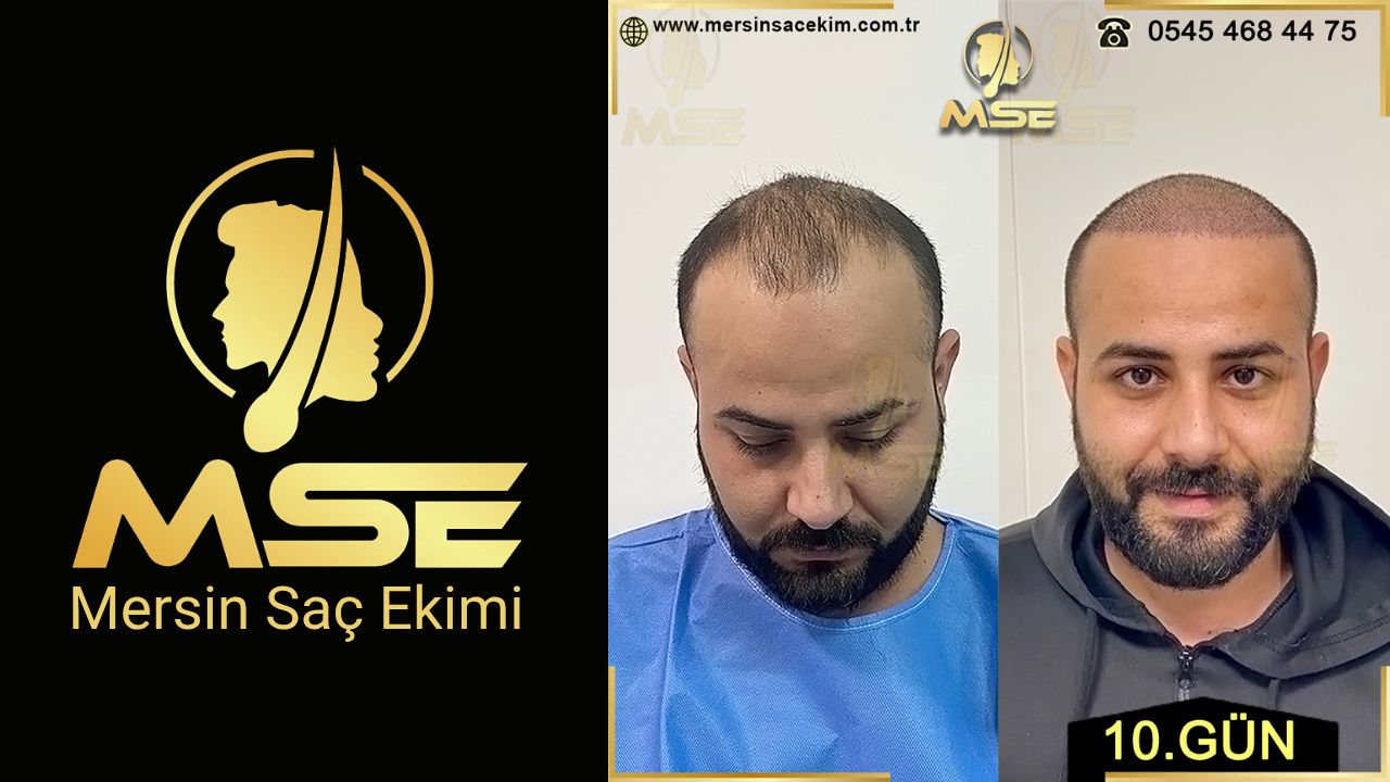 MERSİN SAÇ EKİMİ